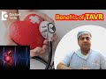 3 Benefits of TRANSCATHETER AORTIC VALVE REPLACEMENT(TAVR)-Dr.Durgaprasad Reddy B | Doctors' Circle