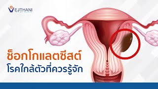 ช็อกโกแลตซีสต์ โรคใกล้ตัวที่ควรรู้จัก l Vejthani Hospital