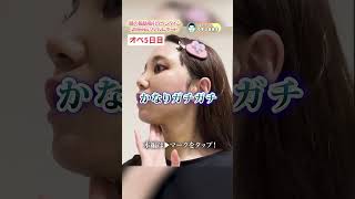 顔の脂肪吸引で顔がパンパン！！ダウンタイムに密着！