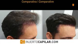 2009 FUE Grafts. Repair case. Temporal peaks. Early regrowth at 5 m. 2009/2017.