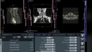 Brakial Pleksus + C MR Nasıl Çekilir? Kanal Radyoloji MR Çekmeyi Öğreniyorum Siemens Magnetom Avanto