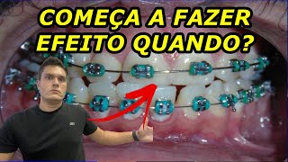 A PARTIR DE QUANTO TEMPO O APARELHO ORTODÔNTICO COMEÇA A FAZER EFEITO? | VERDADE REVELADA!