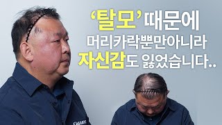 탈모때문에 머리카락 뿐만 아니라 자신감도 잃었습니다(모발이식, 가발, 탈모약, 두피문신중 어떤선택을?)