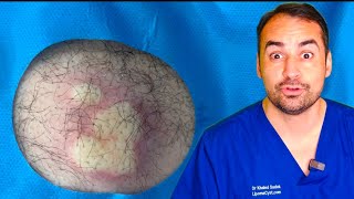 Massive cyst infection drained!