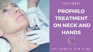 Profhilo Treatment On Neck and Hands  The Cosmetic Skin Clinic