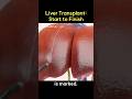 Liver Transplant: Start to Finish