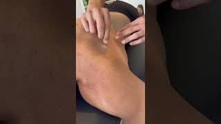 Huge twitch from dry needling of the rotator cuff #dryneedling #rotatorcuff #chiropractic
