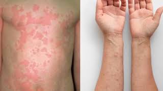 আমবাত: লক্ষণ, কারণ, নির্ণয় ও প্রতিরোধ!  (Urticaria): symptoms, causes, diagnosis and prevention!