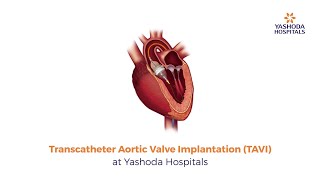 Transcatheter Aortic Valve Implantation (TAVI)  | Heart Valve Replacement Surgery in Hyderabad