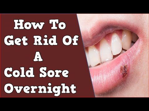 How To Get Rid Of A Cold Sore Overnight, Cold Sore, How To Stop Cold ...