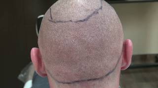 Minimal Scars FUE Hair Transplant Surgery Scars Follicular Unit Extraction Bald Hair Loss Treatment