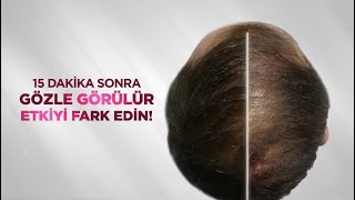 Saç Dökülmesini Önlemek ve Daha Gür Saçlar için İlk Uygulamada Etkili Bioxcin Şampuan ve Serum