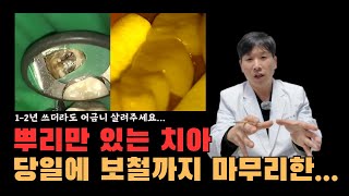 뿌리만 남은 어금니 살려달라는 환자분... 당일에 보철까지 마무리?