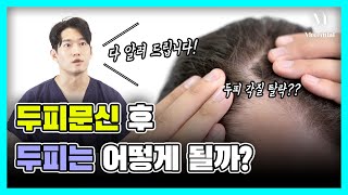 두피 문신 후 두피의 변화 과정과 주의사항