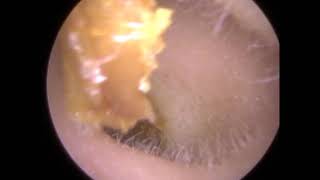 264 - Endoscopic Ear Wax Removal Leicester - Mr Neel Raithatha (The Hear Clinic)