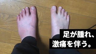 食生活が乱れた挙句、痛風になったブラック企業社員の末路。／A day of gout.