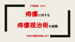 No.05 痔瘻に対する痔瘻根治術の実際をお送りします　#痔瘻　#治療　#痔　#手術