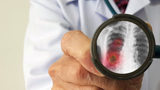 Pneumonia - cauze, simptome și metode de prevenție