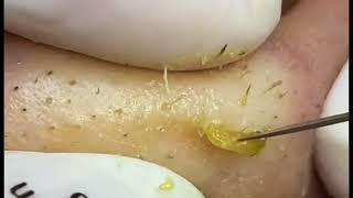 Big Cystic Acne Blackheads Extraction Blackheads #52226