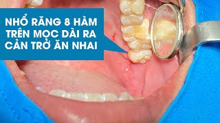 Nhổ răng 8 hàm trên mọc dài ra gây cản trở ăn nhai | Đại tá Bs Nguyễn Qúy Tuệ