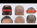 Discover Day 14 of SMART™ FUE Hair Restoration Journey | Glojas Aesthetic Clinic