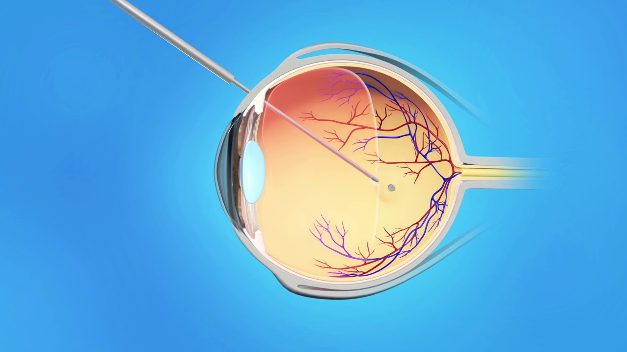 US Ophthalmic Retina Macular Hole Surgery - YouTube