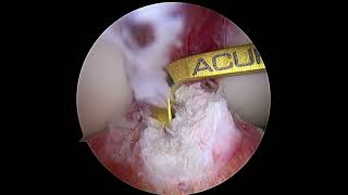 Knee Arthroscopy: ACL Reconstruction (Bone Patellar Tendon Bone Autograft + Meniscus Repair Surgery)