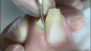Twisted Nail and Effective skill for nail treatment