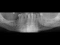 Full Lower jaw teeth extraction before full mouth implants