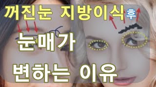 Deep eyes, hollow eyes  physiognomy plastic surgery