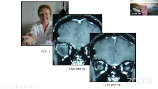 The Keyhole Eyebrow Craniotomy: A versatile fronto lateral approach to the skull base