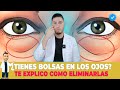 Bolsas en los ojos ¿Qué hacer y cómo prevenirlos? 🐼| DOCTOR LEMUS