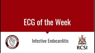 ECG of the Week- Infective Endocarditis