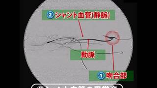 ② シャント血管の異常音