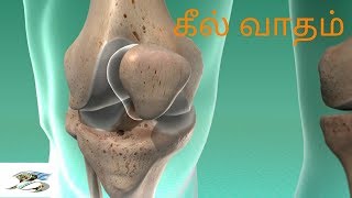 Osteoarthritis-கீல்வாதம்