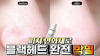 모공 안 넓어지게 블랙헤드, 화이트헤드 박멸하는 ‘진짜’ 방법👃🏻