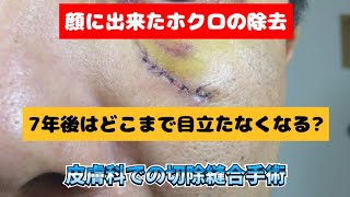 ここまで消える!　ホクロの切除縫合手術痕