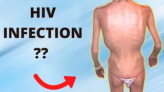 Stages of HIV Infection and their Symptoms