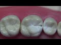 class ii amalgam preparation 3 mo