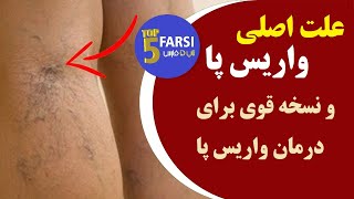 علت اصلی واریس پا و درمان قطعی و ارزان خانگی واریس با