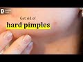 How To Get Rid Of Hard Pimples? - Dr. Urmila Nischal