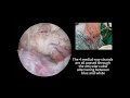 “Mini Incision” Transtendon Double Pulley Suture Bridge Repair of PASTA Lesion