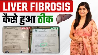 लिवर Fibrosis कैसे होगा ठीक | Reverse Liver Fibrosis Reduce KPA (25.7 to 13.3) | SRIAAS