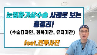 셀라성형외과★ 눈썹하거상수술 사례로 보는 총정리! (수술디자인,회복기간,유지기간) feat. 전후사진