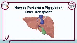 How to Perform a Piggyback Liver Transplant