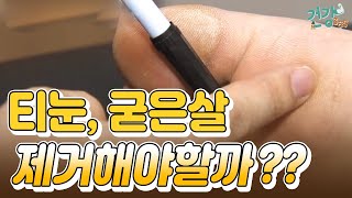 티눈과 굳은살, 꼭 제거해야 할까?? / YTN 라이프