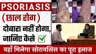 Psoriasis ( छाल रोग ) दोबारा नहीं होगा, जानिए कैसे | यहाँ मिलेगा सोरायसिस का पूरा इलाज  | Dr. Health