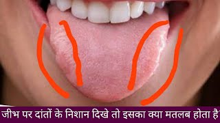 #Glossitis#जीभ पर दांतों के निशान देखे तो क्या करें#Impression of teeth on tongue#जीभ के सूजन की दवा