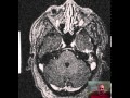 Mastoiditis Brain Abscess DISCUSSION