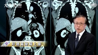 【大愛醫生館】肝癌質變腎上腺 20230515